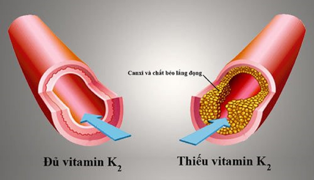 cung cấp đủ vitamin K2 làm giảm vôi hóa động mạch